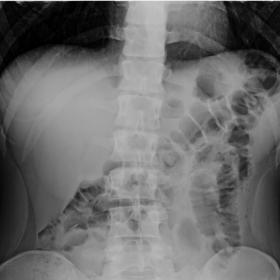 Abdominal radiograph obtained one month earlier shows normal position of both the diaphragmatic cupules