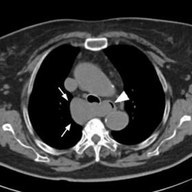 Unenhanced axial (a) and coronal (b) thoracic CT showing a large structure in the right posterior mediastinum (white arrows),
