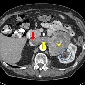 Axial CT scan view through the upper abdominal shows a heterogeneous adrenal tumor (yellow star) infiltrating the renal hilum