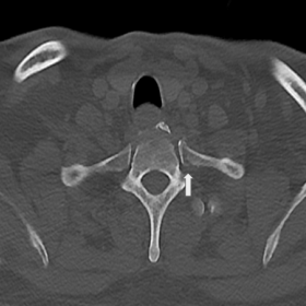 Axial CT image shows undisplaced fracture with the cortical break in the left neck of first rib (white arrow)