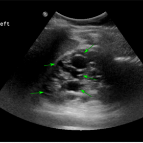 US scan of the left kidney demonstrating normal size and echogenicity with intact cortico-medullary differentiation. The bipo