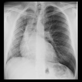 PA (a) and lateral (b) chest X ray shows volume loss of right lung, mediastinal ipsilateral shift and absent hilar shadow. Al