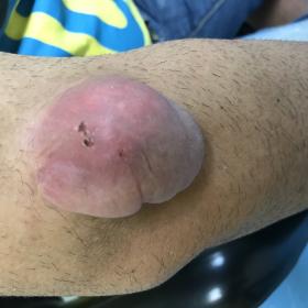 Solitary large-sized nodule with diameter of 7 cm of reddish color and semi-circular shape on the right elbow of patient of 3