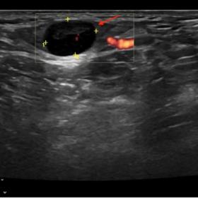 Neck ultrasound shows an enlarged lymph node, with diffuse cortical thickness, preserving central hilum (arrow) (a: Power Dop