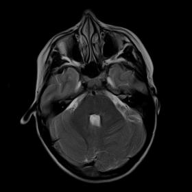Brain MRI of a 9-year-old girl performed as part of the work-up for neurofibromatosis due to several café-au-laît spots. An