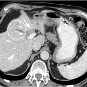 CT study showed dilated central intra-hepatic bile ducts (dotted circles) and a vascular intraluminal mass distending the com