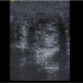 Ultrasound image of the polypoid colonic structure, with a diameter of around 20mm