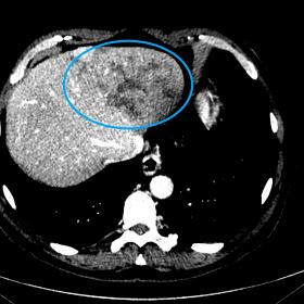 Axial contrast-enhanced venous CT scan of the upper abdomen shows left hepatic global hypodensity with patchy linear areas of