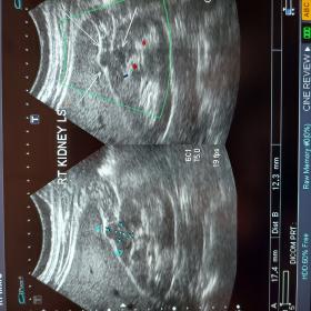 Ultrasound images of right kidney showing an isoechoic partly exophytic right mid region renal cyst (arrows)