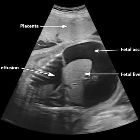 Gross fetal ascites with bilateral pleural effusions