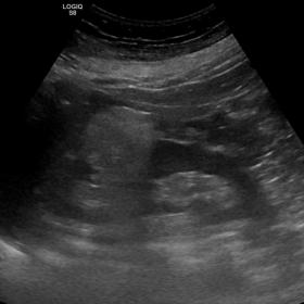 A homogeneously hyperechoic lesion is noted in the upper pole of the right kidney