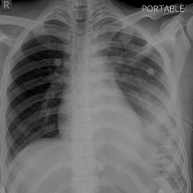 Supine chest radiograph shows left mild hemothorax with an intercostal drainage tube in situ. The left diaphragmatic outline 