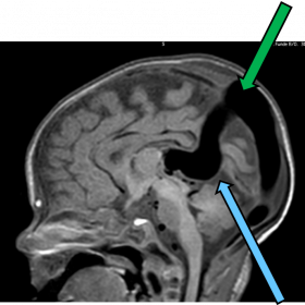 Pre-embolization: Sagittal T1W (a) , Axial T2W (b), 3D angiography image (c) showing dilated prosencephalic vein (blue arrow)