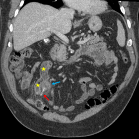 Coronal contrast-enhanced abdominal CT (a, b: magnified image): Diverticulum (blue arrow) arising from the antimesenteric bor
