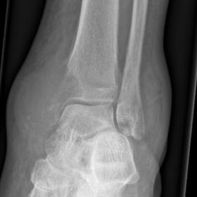 Radiograph showed a large soft issue lesion at the medial aspect of the ankle with underlying medial malleolus destruction