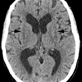 Initial axial non-contrast brain CT shows slight hypodensity in both putamina (A, arrows)