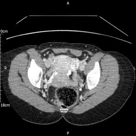 CT axial section showing dilated pelvic veins (varices) more to the left
