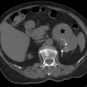 Axial non-enhanced CT images showing a tumoral lesion in the left adrenal gland (star) with calcifications (black arrow) and 
