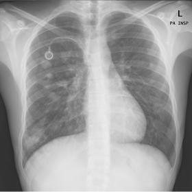 Postero-anterior (PA) Chest X-ray a few hours after port-a-cath insertion shows the catheter inserted into the right subclavi