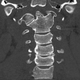 Coronal view of the cervical spine through C2, showing a dysplastic odontoid process and fusion of the left lateral masses of