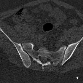 Axial CT showing minimal sclerosis at the right sacroiliac joint shown with the arrow
