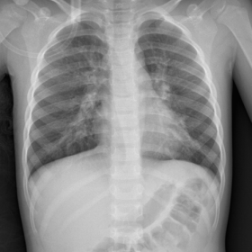 Chest x-ray in supine position: it shows hilar enlargement and marked thickening of the mid-basal peribronchovascular interst