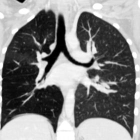 Coronal CT image with maximum intensity projection (MIP) shows right hyperlucent lung with diminished vascularity