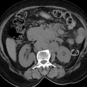Plain CT abdomen axial section showswell defined, multiple conglomerulate lymph nodesin  peri-pancreatic region