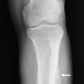 Solid, thick, undulated periosteal reaction and soft tissue swelling especially in the mid-to distal portion of left tibia an