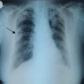 Chest X-ray PA view showing right middle zone non- homogenous opacity (arrow mark) with central lucency and thick walls, sugg