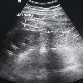 Ultrasound image showing bulky hypoechoic left psoas muscle with mild anterolaterally displaced left kidneys (arrows)