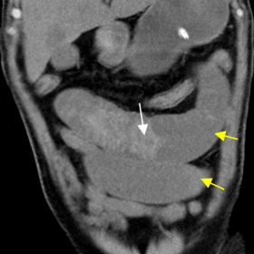 Non-contrast coronal CT image of the abdomen shows dilated proximal jejunal loops (yellow arrows) with intraluminal hemorrhag