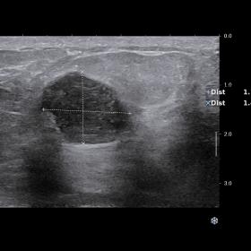 Ultrasound examination of the left axillary region showed well circumscribed round hypoechoic lesion on B-mode (A).