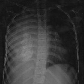Chest radiograph PA view : Complete opacification of the right hemithorax with focal area of calcification