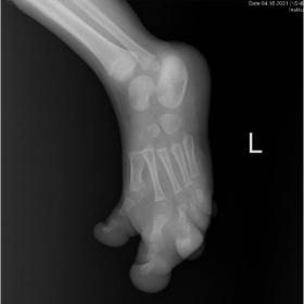 Radiograph: Marked soft tissue overgrowth of the first three toes with splayed and lengthened phalanges
