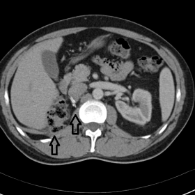 CT after e.v. contrast injection is consistent with right nephrectomy, without recurrence signs in renal bed (arrows)