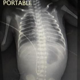 Chest and abdominal radiograph show gas-filled stomach with no distal air in keeping with single bubble sign likely attribute