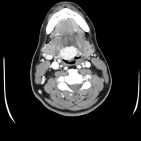 Non-contrast axial CT neck. There is a hyperdense mass at the base of the tongue due to its Iodine content