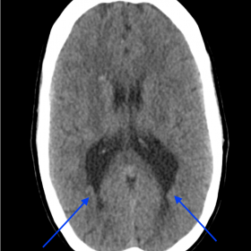 Noncontrast CT head axial and coronal images demonstrate abnormal nodular contour along the lining of the bilateral posterior