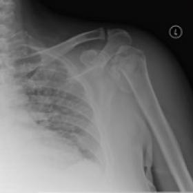 X-rays of the left shoulder showing multifragmentary fracture of proximal humerus with posterior dislocation of the humeral h