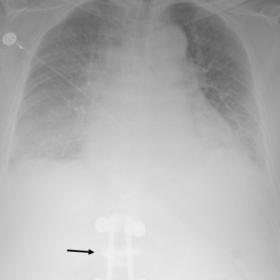 Chest radiography revealed changes associated with cardiac failure – enlarged heart silhouette, interstitial edema and bilateral pleural effusions. Additionally, lumbar osteosynthetic material (black arrow) is seen