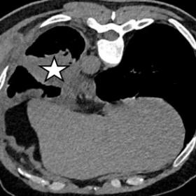 Axial section of HRCT thorax showing left lower lobe lesion (star) of lung in mediastinal window