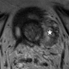 Axial T2-weighted imaging (a) presence of a slightly heterogeneous and large elongated lesion (white star) centered in the an