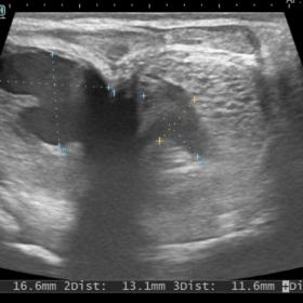 Gray scale ultrasonography image shows irregular hypoechoic areas  with internal moving  echoes noted in bilateral corpora ca