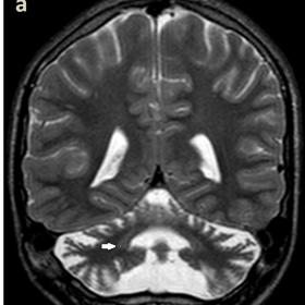 MRI from patient 1. Coronal (a, e) and axial (b, f) T2 FSE showing cerebellar atrophy with splayed superior cerebellar pedunc