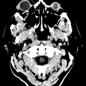 Unenhanced CT Head. Right-sided proptosis and a dilated ipsilateral superior ophthalmic vein
