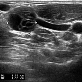 Neck ultrasound revealed a lymph node with cystic transformation and internal septations at right sided third cervical level 