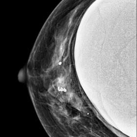 Unremarkable mammography of the right breast 8 years before (CC view)