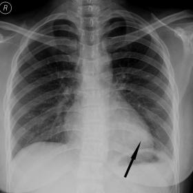 Frontal chest radiograph shows a nodular opacity in left lower zone (arrow)