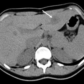 A subcapsular, hypodense and non-calcified focal liver lesion, measuring 2.5 cm is seen on the left liver lobe (arrow). No ot